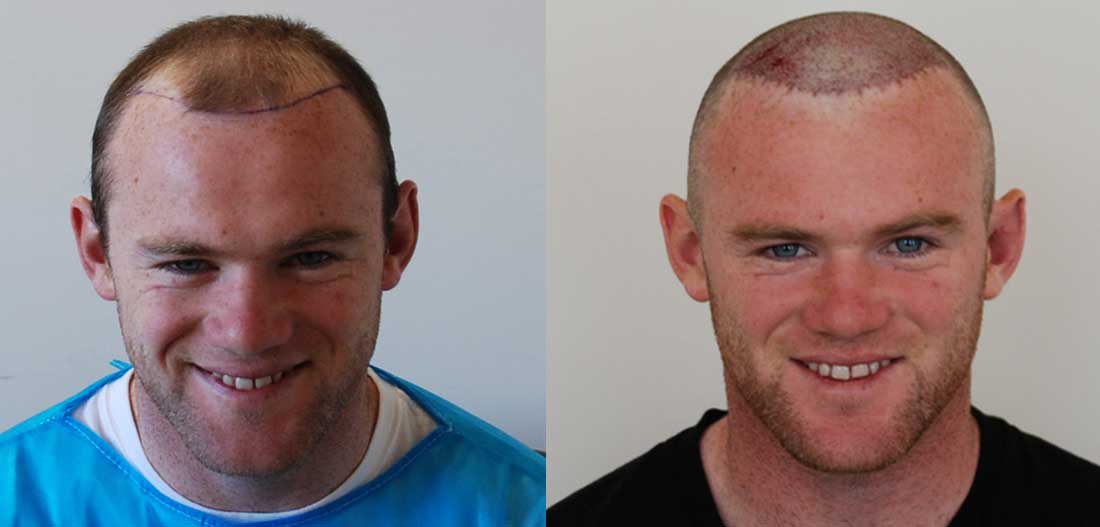 Wayne Rooney Hair Transplant - Famous hair restoration impact on Ireland